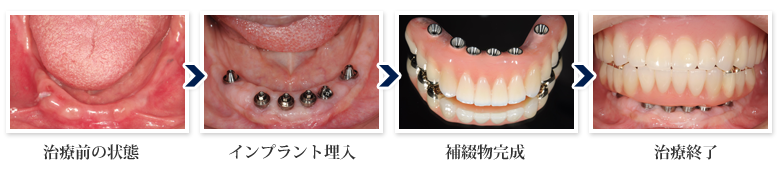 All-on-4及びAll-on-6:インプラント症例1