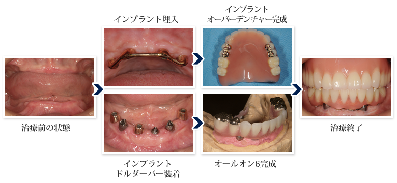 インプラントオーバーデンチャー:インプラント症例3