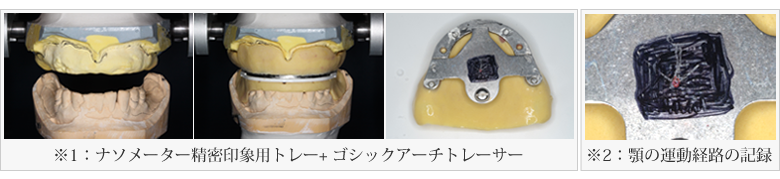 超精密義歯(入れ歯)について
